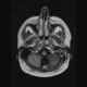 Chordoma of clivus, preoperative: MRI - Magnetic Resonance Imaging
