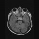 Chordoma of clivus, preoperative: MRI - Magnetic Resonance Imaging