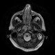 Chordoma of clivus, preoperative: MRI - Magnetic Resonance Imaging