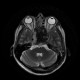 Chordoma of clivus, preoperative: MRI - Magnetic Resonance Imaging