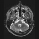 Chordoma of clivus, preoperative: MRI - Magnetic Resonance Imaging