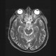 Chordoma of clivus, preoperative: MRI - Magnetic Resonance Imaging
