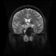 Chordoma of clivus, preoperative: MRI - Magnetic Resonance Imaging