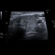 Lymphocytic thyroiditis, chronic thyreopathy: US - Ultrasound