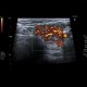 Lymphocytic thyroiditis, chronic thyreopathy: US - Ultrasound
