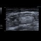 Lymph nodes, chronic: US - Ultrasound