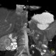 Circumaortic renal vein: CT - Computed tomography