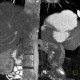 Circumaortic renal vein: CT - Computed tomography
