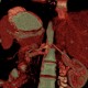 Circumaortic renal vein: CT - Computed tomography