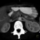 Circumaortic renal vein: CT - Computed tomography