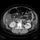 Circumarotic left renal vein: CT - Computed tomography