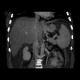 Circumarotic left renal vein: CT - Computed tomography