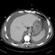 Liver cirrhosis, ascites, portal colonopathy, colopathy: CT - Computed tomography