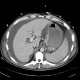 Liver cirrhosis, ascites, portal colonopathy, colopathy: CT - Computed tomography