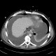 Liver cirrhosis, ascites, portal colonopathy, colopathy: CT - Computed tomography