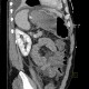 Liver cirrhosis, ascites, portal colonopathy, colopathy: CT - Computed tomography