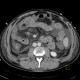 Liver cirrhosis, ascites, portal colonopathy, colopathy: CT - Computed tomography