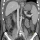 Liver cirrhosis, ascites, portal colonopathy, colopathy: CT - Computed tomography