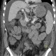 Liver cirrhosis, ascites, portal colonopathy, colopathy: CT - Computed tomography
