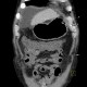Liver cirrhosis, ascites, portal colonopathy, colopathy: CT - Computed tomography