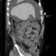 Liver cirrhosis, ascites, portal colonopathy, colopathy: CT - Computed tomography