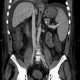 Liver cirrhosis, ascites, portal colonopathy, colopathy: CT - Computed tomography
