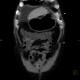 Liver cirrhosis, ascites, portal colonopathy, colopathy: CT - Computed tomography