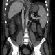 Liver cirrhosis, ascites, portal colonopathy, colopathy: CT - Computed tomography