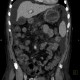 Liver cirrhosis, ascites, portal colonopathy, colopathy: CT - Computed tomography