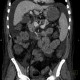 Liver cirrhosis, ascites, portal colonopathy, colopathy: CT - Computed tomography