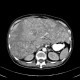 Multiple myeloma, venooclusive disease of liver, hypervascular nodules: CT - Computed tomography