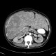 Multiple myeloma, venooclusive disease of liver, hypervascular nodules: CT - Computed tomography