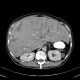 Multiple myeloma, venooclusive disease of liver, hypervascular nodules: CT - Computed tomography