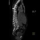 Multiple myeloma, venooclusive disease of liver, hypervascular nodules: CT - Computed tomography