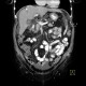 Liver cirrhosis: CT - Computed tomography