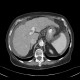 Liver cirrhosis: CT - Computed tomography