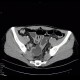 Crohn's disease of ileum, CT enterography: CT - Computed tomography
