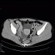 Crohn's disease of ileum, CT enterography: CT - Computed tomography