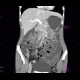 Crohn's disease of ileum, CT enterography: CT - Computed tomography