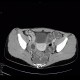 Crohn's disease of ileum, CT enterography: CT - Computed tomography