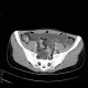 Crohn's disease of ileum, CT enterography: CT - Computed tomography