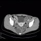 Crohn's disease of ileum, CT enterography: CT - Computed tomography