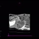 Crohn's disease of ileum, CT enterography: CT - Computed tomography