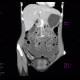 Crohn's disease of ileum, CT enterography: CT - Computed tomography