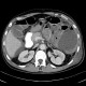 Crohn's disease of small bowel, abdominal abscess: CT - Computed tomography