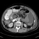 Crohn's disease of small bowel, abdominal abscess: CT - Computed tomography