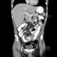 Crohn's disease of small bowel, abdominal abscess: CT - Computed tomography