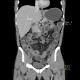 Crohn's disease of small bowel, abdominal abscess, CT enterography: CT - Computed tomography