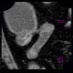 Crohn's disease, ileocecal resection, stenosis of anastomosis: CT - Computed tomography