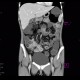 Crohn's disease of ileum, CT enterography, 2010: CT - Computed tomography
